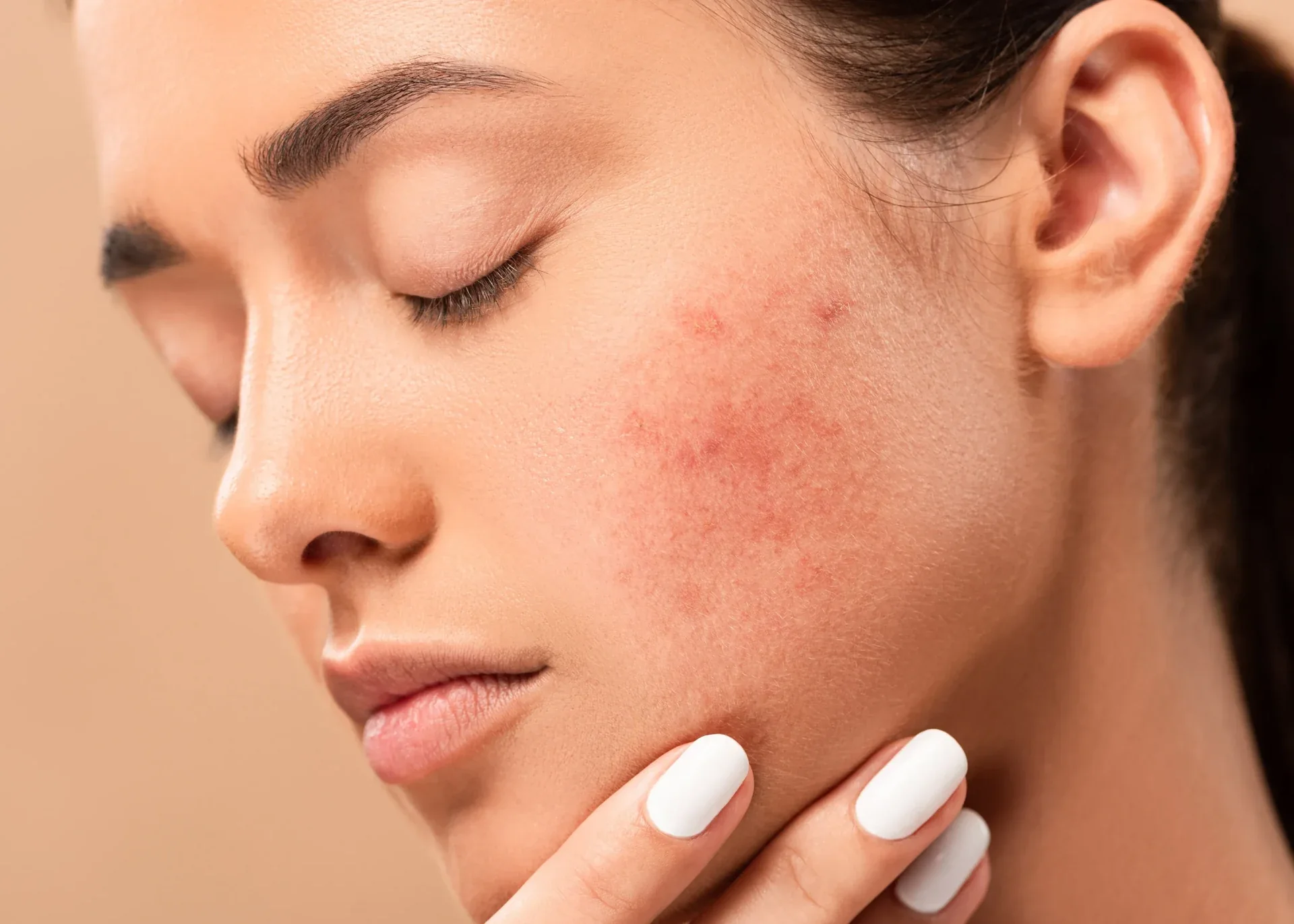 Close-up of acne blemishes on a woman’s cheek.