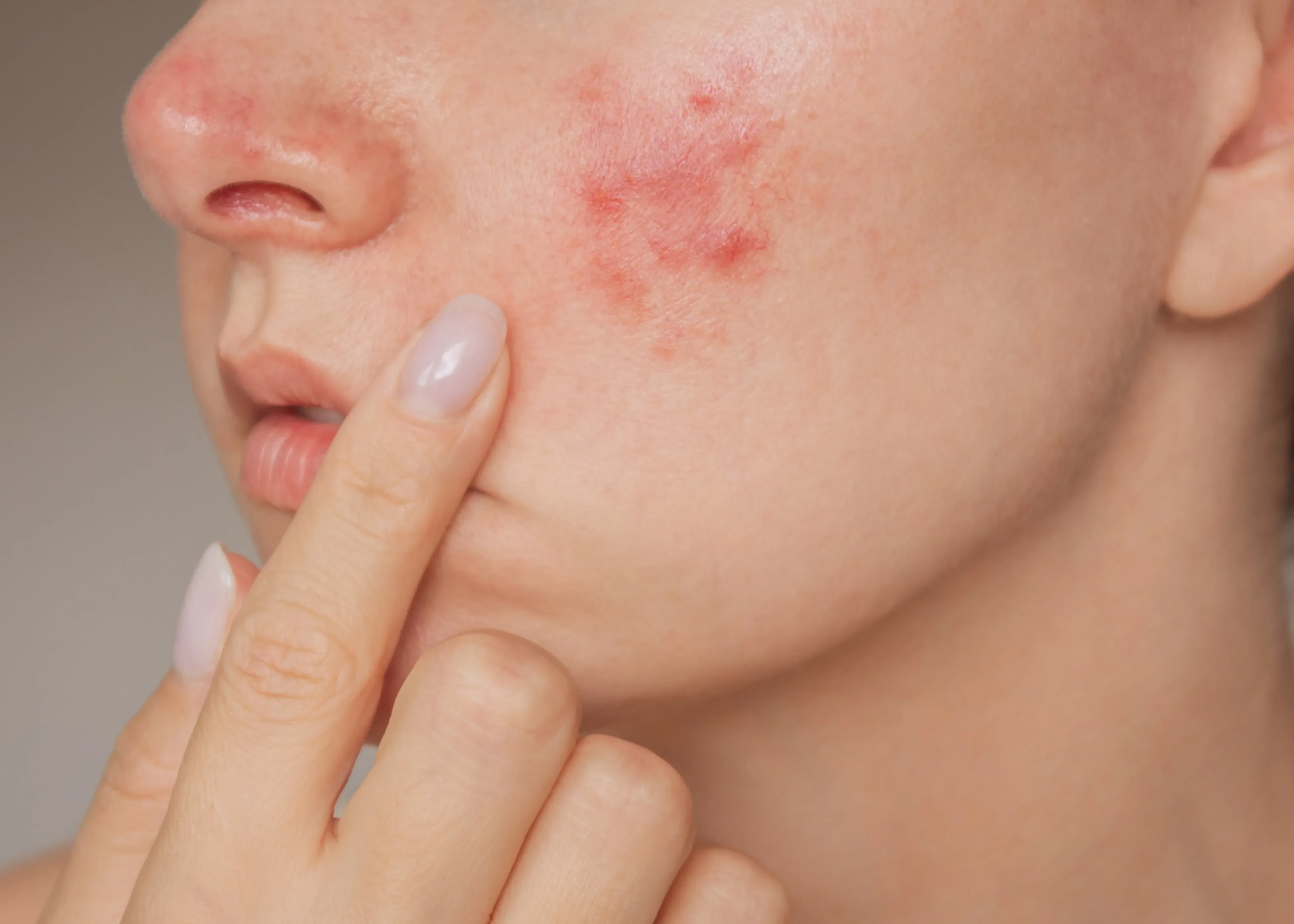 Close-up of redness and blemishes on a cheek.