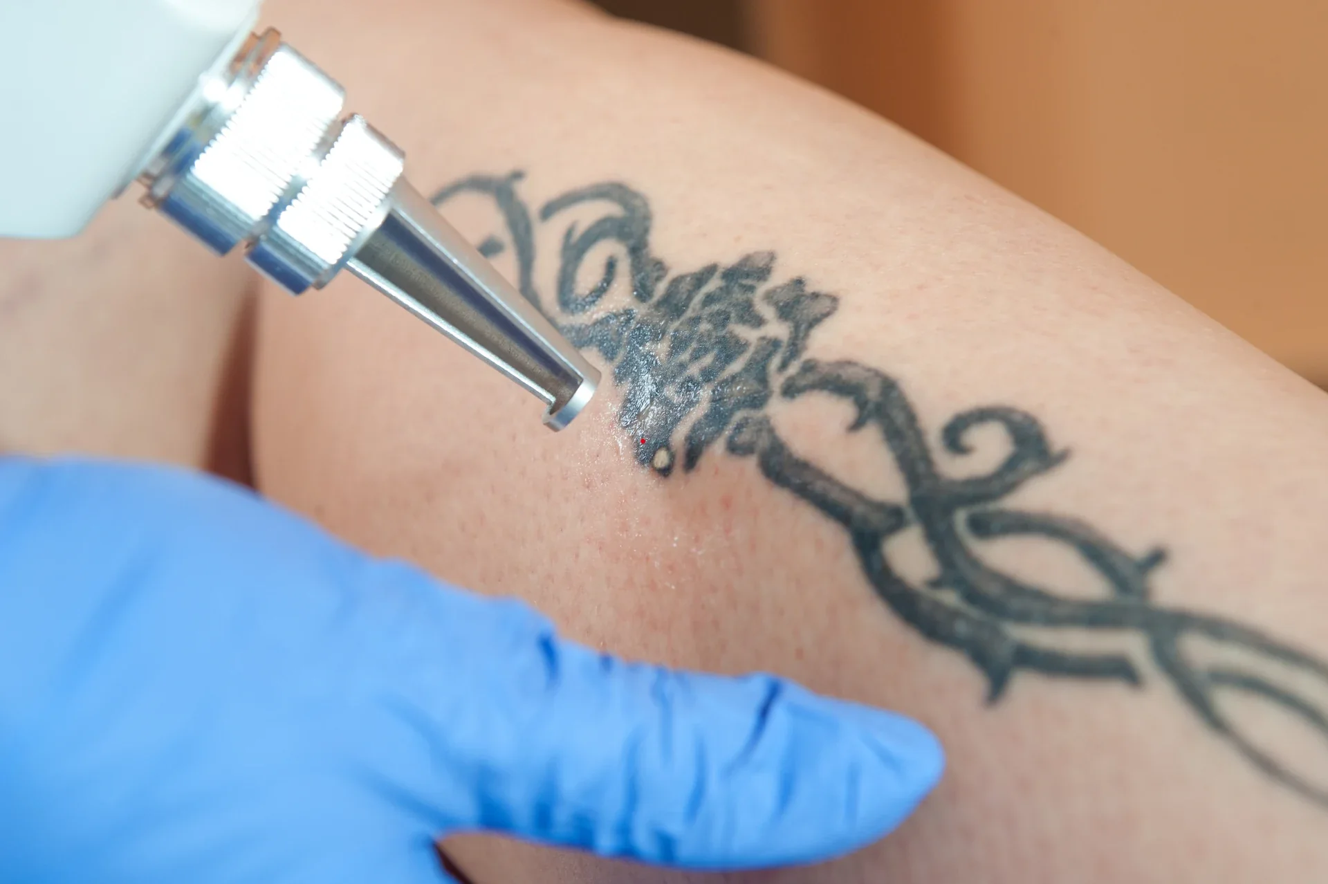 Gloved practitioner using a laser device on an arm tattoo.