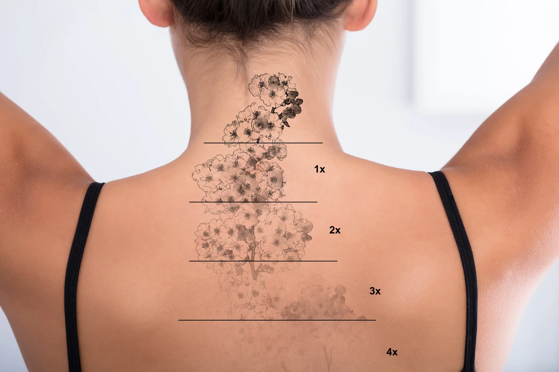 Illustration of a floral back tattoo fading through stages of removal.